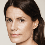 Restylane-Female-Pia