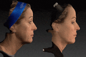 Global facial rejuvenation