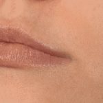 DrSibthorpe_Lip_fillers_01