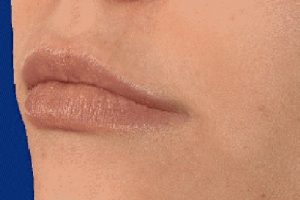 Lip fillers
