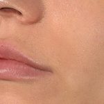 DrSibthorpe_Lip_fillers_02