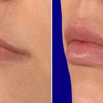 Lips-before-after-1-2
