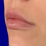 Lip fillers after treatment