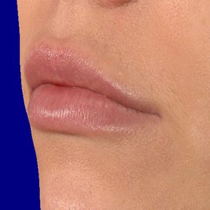 Lip fillers after treatment