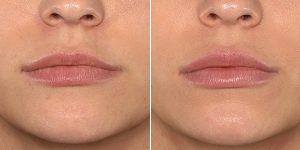 lip fillers before after