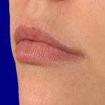 Lip fillers before treatment