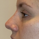Battersea Nose Dermal Fillers After